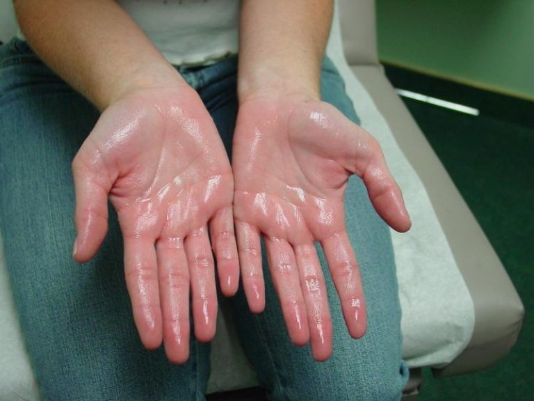 Hyperhidrosis-Treatment